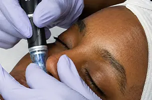 Close view of a SkinPen Oak Lawn microneedling device treating the forehead during a skin rejuvenation session