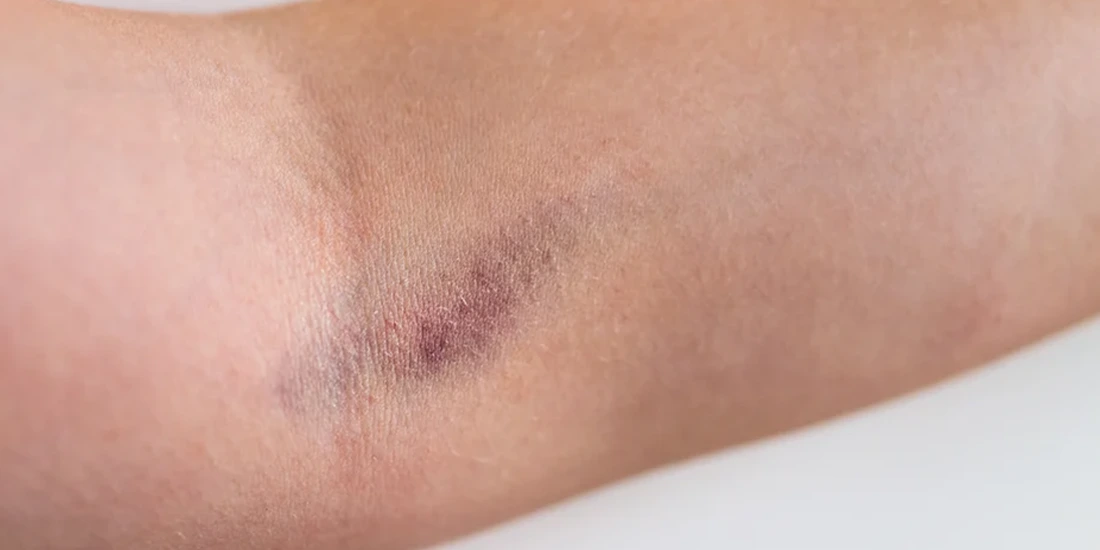 Bruising after iv Infusion | infinite dripz